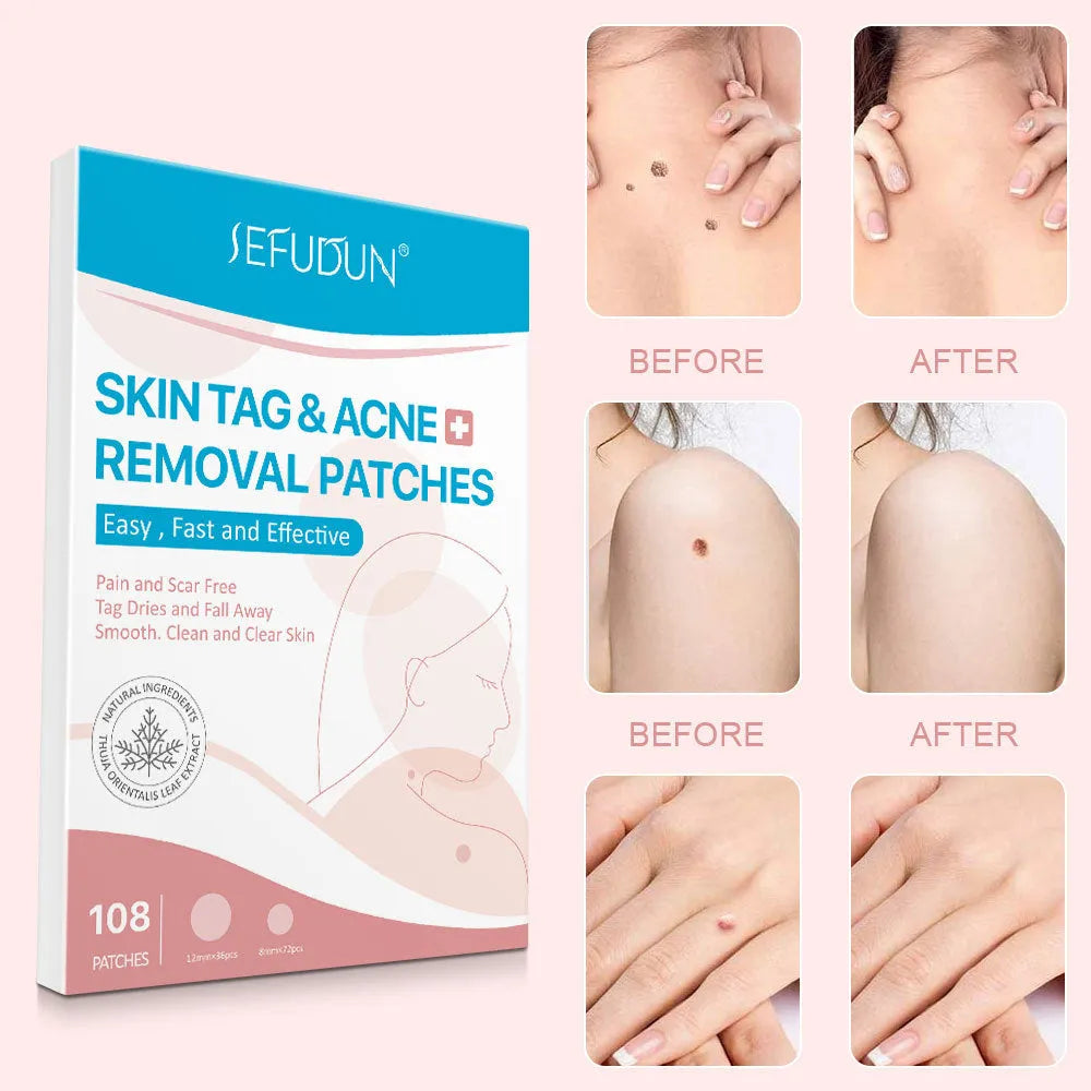 108 white Vitamin A wart and skin tag remover patches for home use
