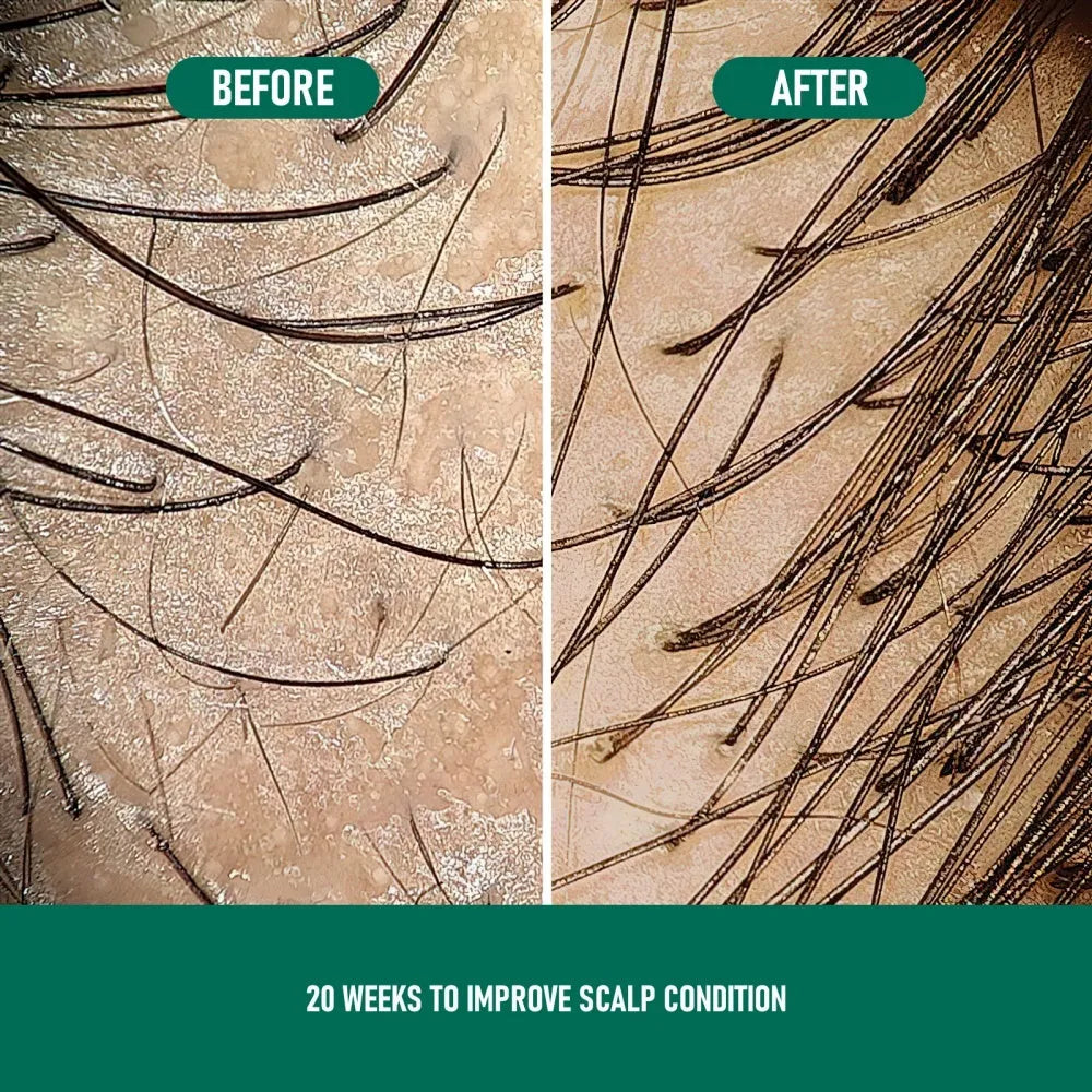 60ml canister of 5% minoxidil anti-hair loss foam mousse with a white pump applicator.