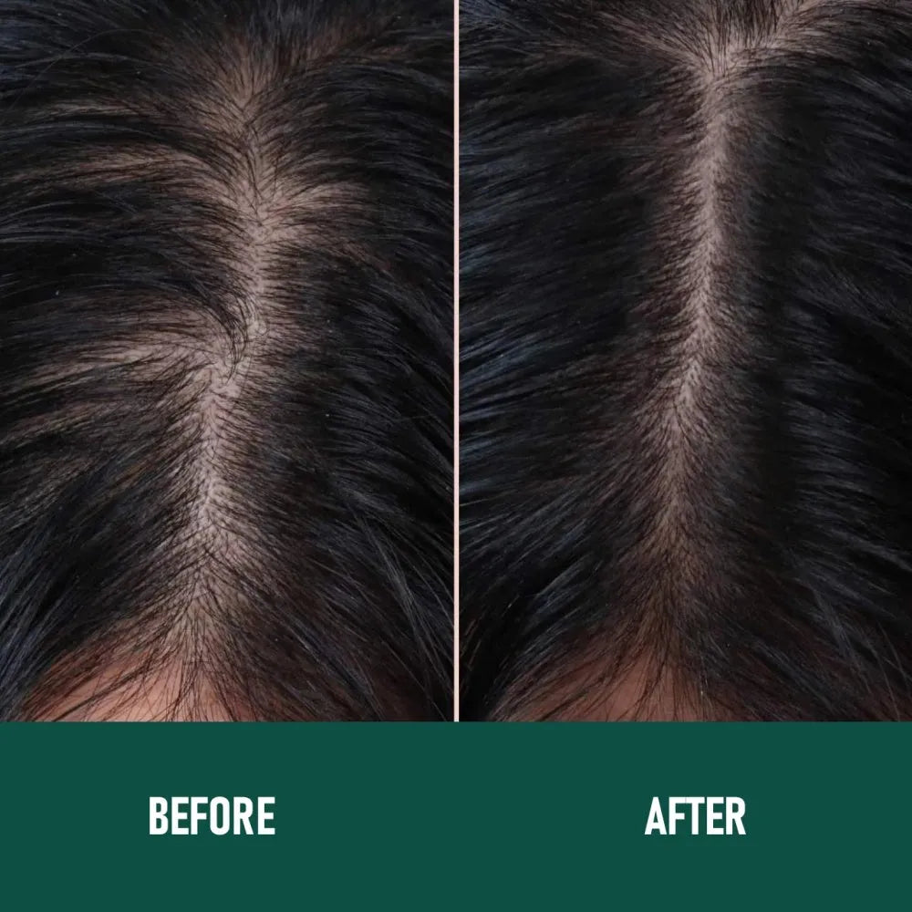 60ml canister of 5% minoxidil anti-hair loss foam mousse with a white pump applicator.