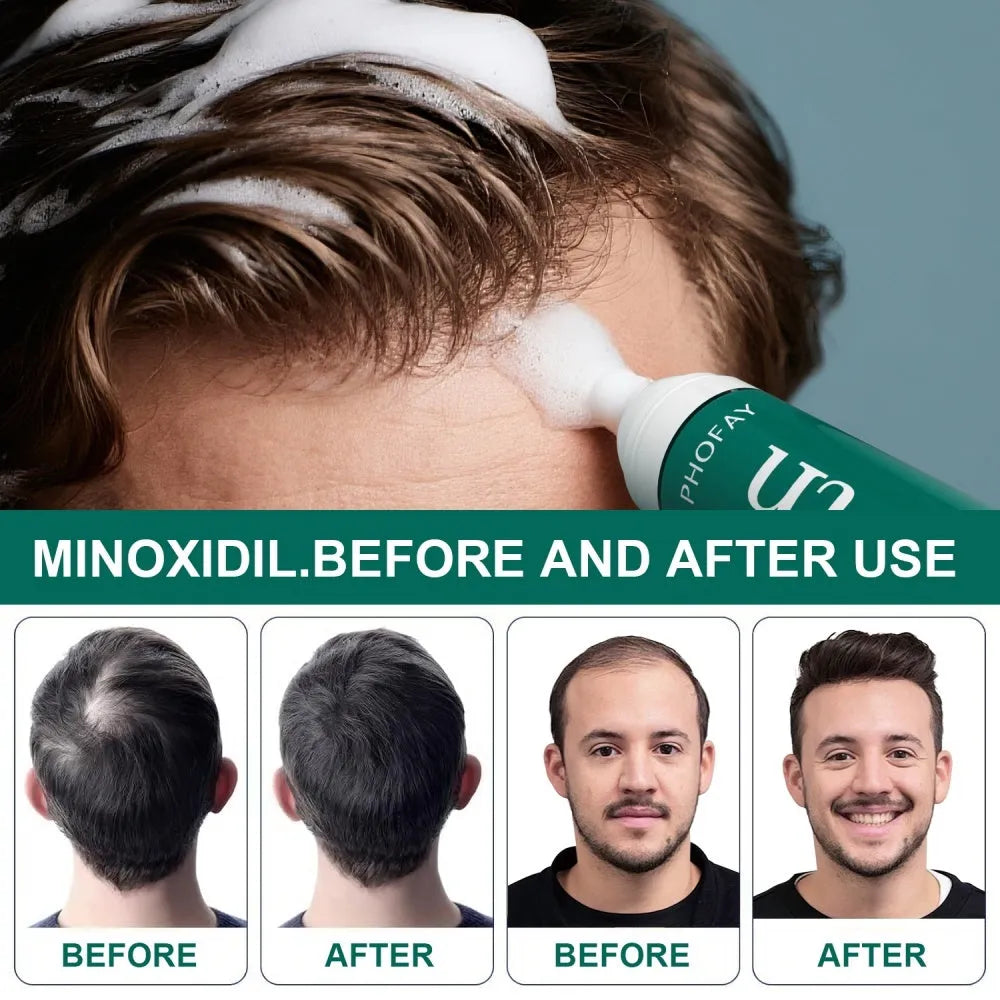 60ml canister of 5% minoxidil anti-hair loss foam mousse with a white pump applicator.
