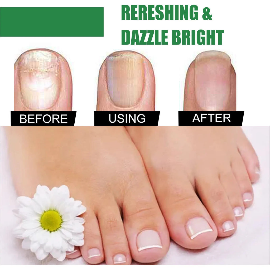 30ml tea tree oil nail repair solution bottle for thickened hand and foot nails
