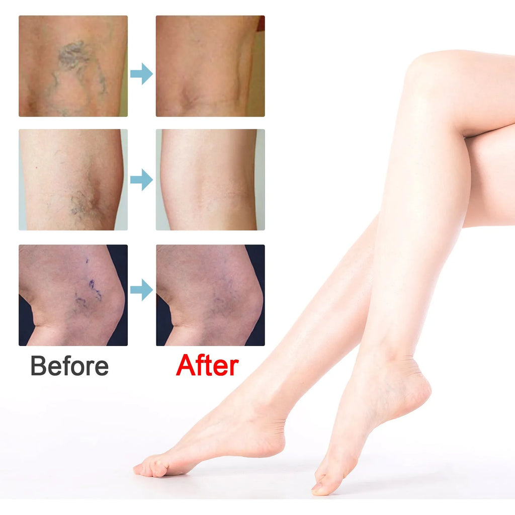 20g vein repair cream tube for leg vein and tendon bulge relief