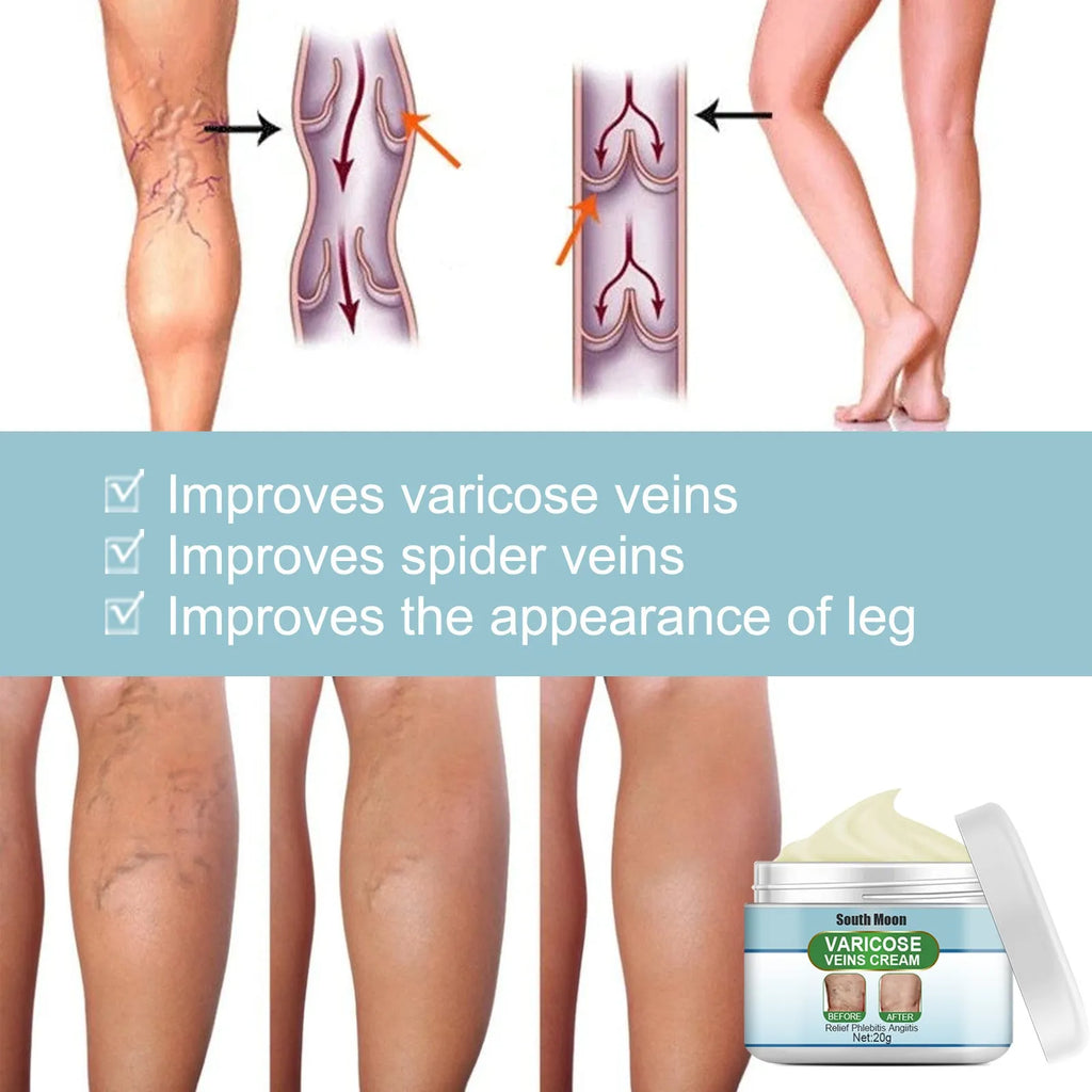 20g vein repair cream tube for leg vein and tendon bulge relief