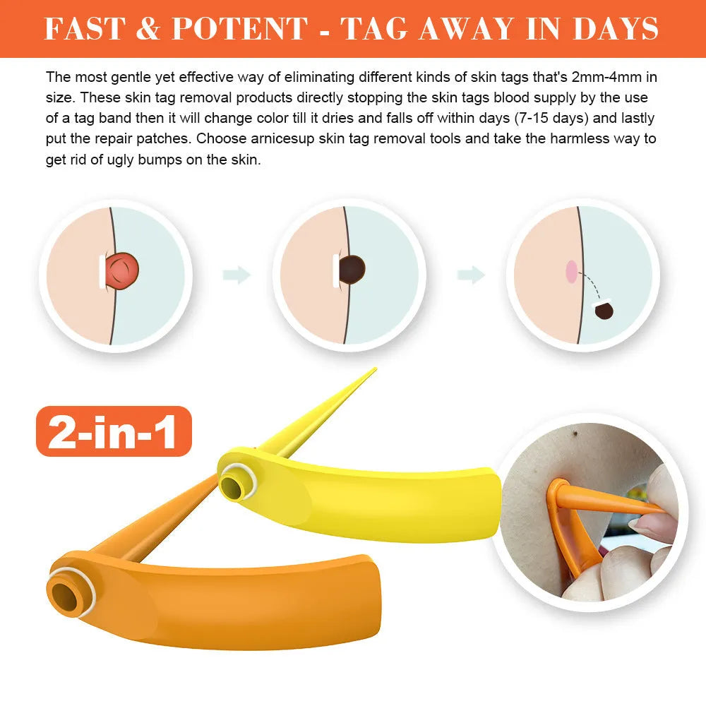Orange wart removal tool kit with two devices, rubber rings, alcohol swabs and instructions