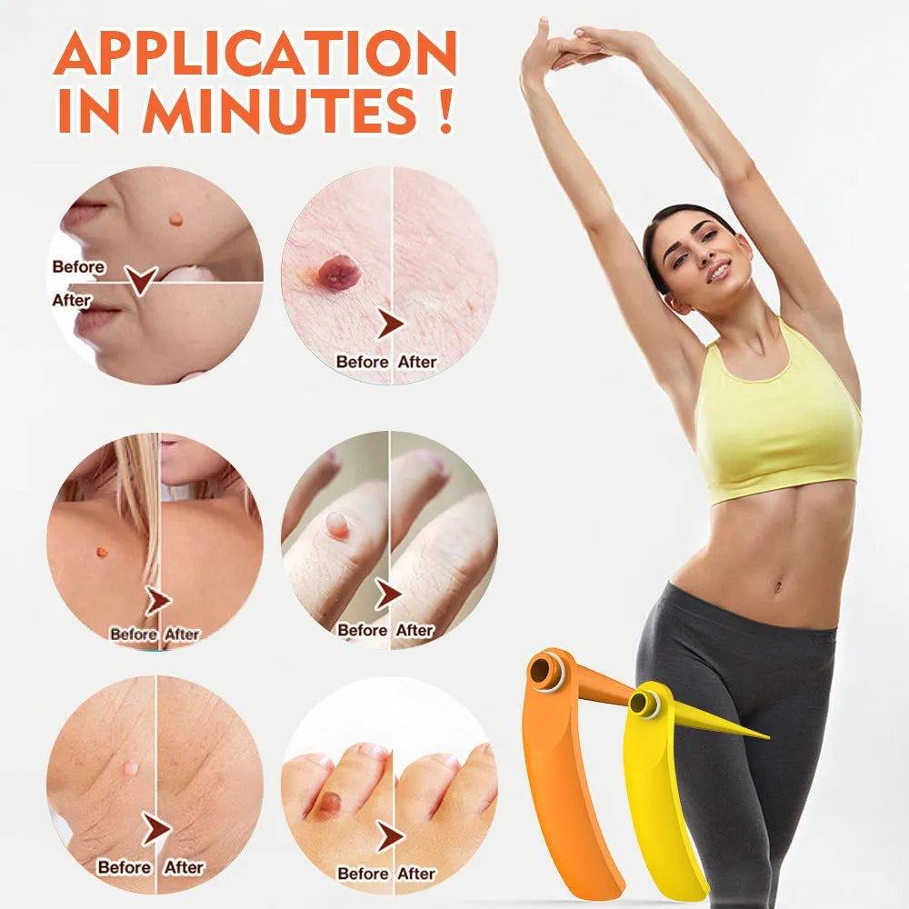 Orange wart removal tool kit with two devices, rubber rings, alcohol swabs and instructions