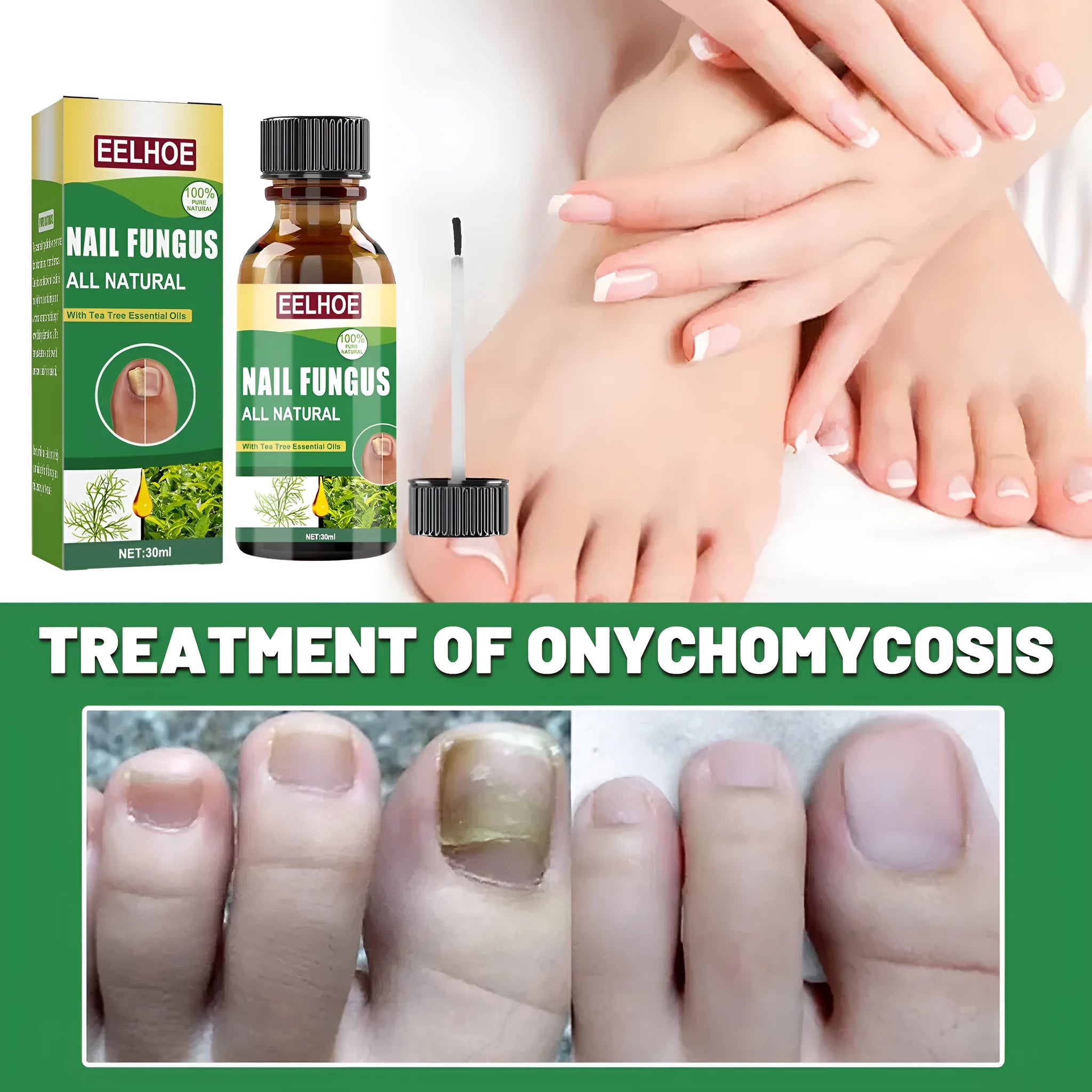 30ml tea tree oil nail repair solution bottle for thickened hand and foot nails