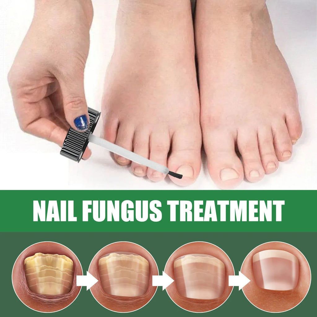 30ml tea tree oil nail repair solution bottle for thickened hand and foot nails