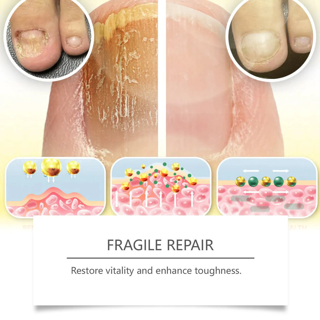 50ml nail fungus care solution bottle with bee venom and peppermint oil ingredients