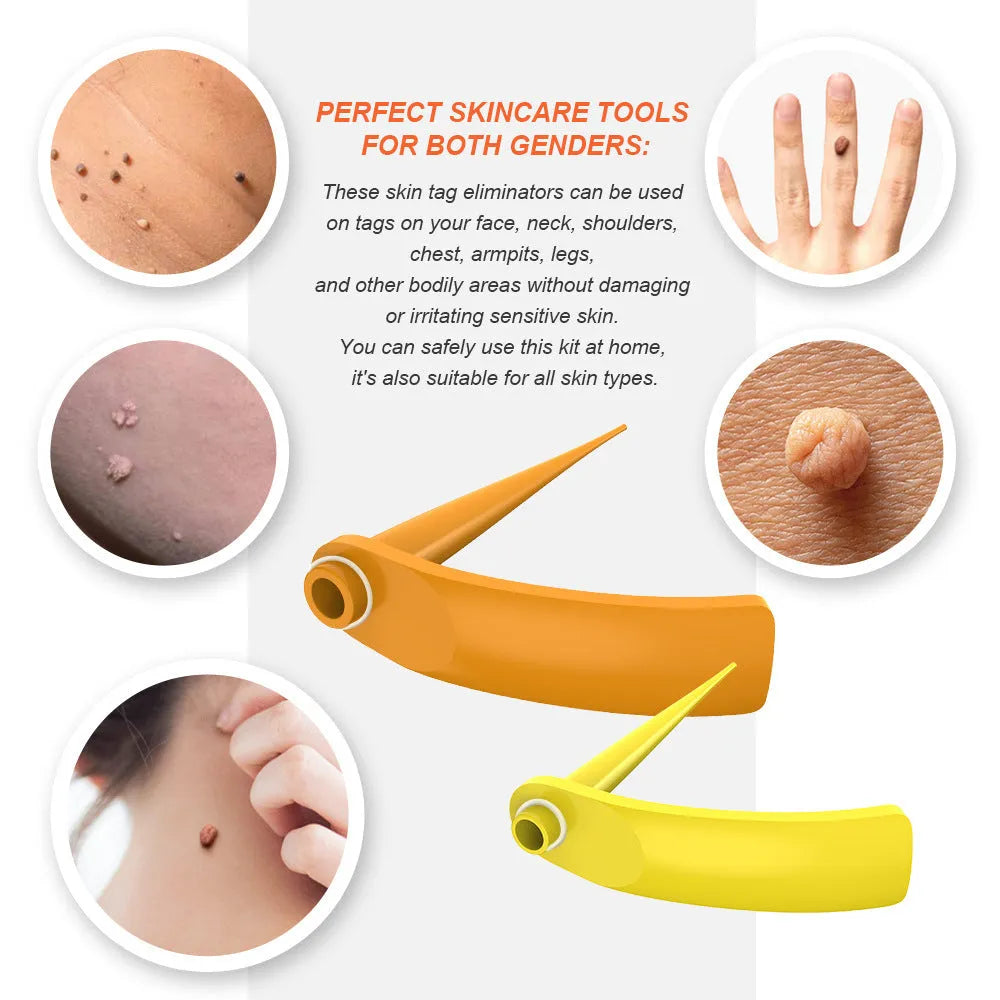 Orange wart removal tool kit with two devices, rubber rings, alcohol swabs and instructions